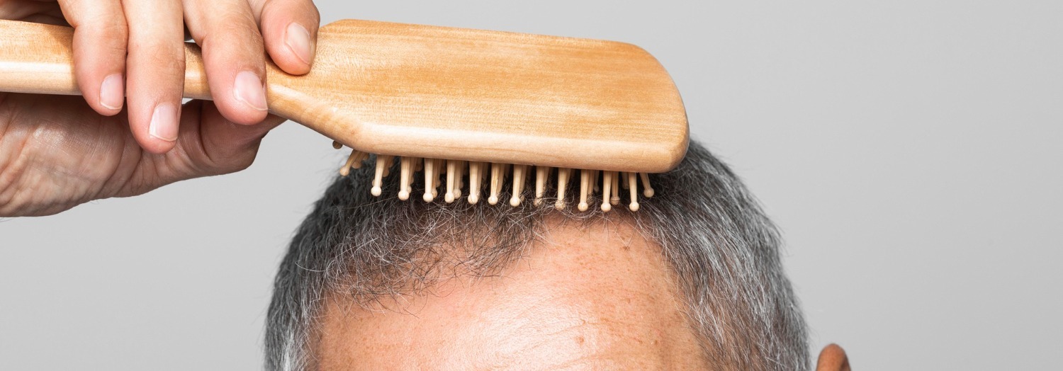 Haarausfall – Formen und Unterschiede